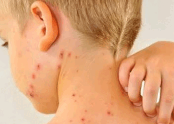 کیرالہ میں اچانک چکن پاکس کے 100 سے زیادہ معاملات درج