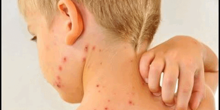 کیرالہ میں اچانک چکن پاکس کے 100 سے زیادہ معاملات درج